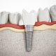 Implanty zębów koszt i rodzaje tytanowe cyrkonowe